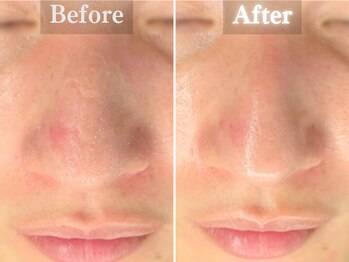 ボーンオム(Born Homme)/毛穴洗浄＋美容液導入：20代女性