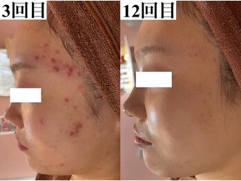 ハリト エステ(HaRi&)/毛穴洗浄/熊本/ハーブピーリング