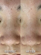 ベルミーランド MEGAドン・キホーテ草加/毛穴ケアBeforeAfter