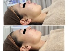 デサフィオ(Desafio)/全顔照射