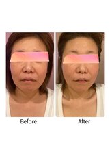 ナナイロ(nanairo)/ポテンツァ×エクソソーム