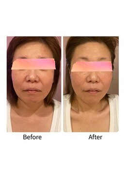 ナナイロ(nanairo)/ポテンツァ×エクソソーム