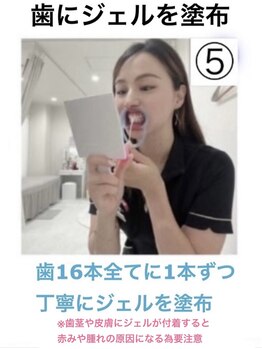 ホワイトニングショップ 今治店/ホワイトニング方法5