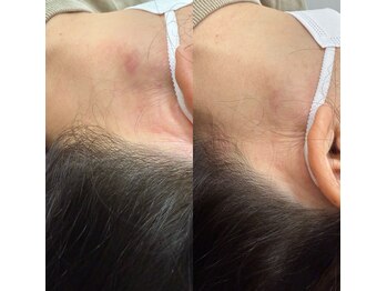 ハーモニーフィットネス 赤坂(Harmony Fitness)/謎の湿疹改善