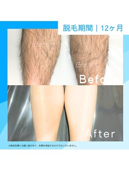 メンズクリア 溝ノ口マルイ店/【メンズクリア】お客様の施術例