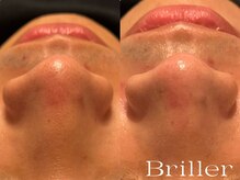 ブリエ(Briller)/毛穴洗浄＋鎮静パック