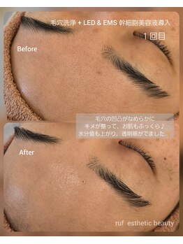 ルフ エステティック ビューティー(ruf esthetic beauty)/毛穴洗浄+LED&EMS 幹細胞導入