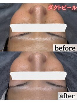 ケーブロッサムビューティーサロン(K Blossom Beauty Salon)/ダクトピールのビフォーアフター
