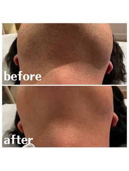 ベイス(BASE)/ヒゲ脱毛BeforeAfter