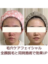 ビーボヌール(be-bonheur)/全顔脱毛＋肌管理フェイシャル