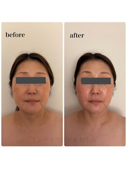インディラグゼ 麻布十番の写真/【麻布十番】人気のインディバフェイシャルで、むくみを解消しスッキリ美人に♪ゆったりとした癒し時間を♪