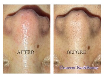クレセントビューティー たまプラーザ店(Crescent Beauty)/大人気毛穴エクストラクション★