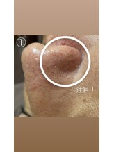 エステサロン桜/鼻横の毛も根っこからキャッチ