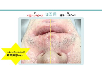 スターポルト(Star-Porte)/鼻下脱毛