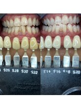 トウキョウスワーズ 池袋店(TOKYO SWRS)/#ホワイトニング #池袋 #渋谷