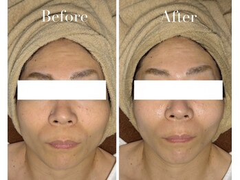 アブニールブリヨン/2BBioハーブピーリング/肌質改善