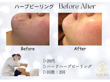 ユアーズ ビューティー(YOURS beauty)/オーダーメイドハーブピーリング