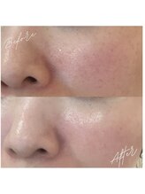 グレアージュ(GLEAGE)/くすみ毛穴レス水光肌コース！