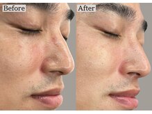 あすはれ/肌悩みには人気No.1ララピール