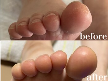 ドクターネイル爪革命 札幌本店/症例紹介22 たこ