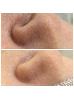 チョチョワンプラス(緒々one+)/毛穴洗浄×顔脱毛でツルツル