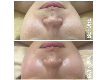 ルルボーテ(Loulou Beaute)の写真/【毛穴の黒ずみ・開き・凹凸に】色んなタイプの毛穴悩みに、自分に合った改善メニューでスッピン美肌へ♪