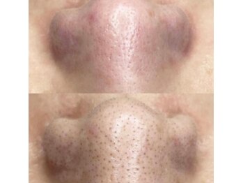 ユニクリア 佐賀(Uniclear)の写真/【毛穴悩み】毛穴黒ずみ・毛穴詰まり・毛穴開き【大人気ハイドロスキン+光フォトIPL/RF】