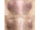 ユニクリア 佐賀(Uniclear)の写真/【毛穴悩み】毛穴黒ずみ・毛穴詰まり・毛穴開き【大人気ハイドロスキン+光フォトIPL/RF】