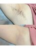 【選べる部分脱毛】Sパーツ脱毛◇気になる部分だけ♪都度払い