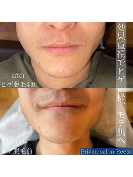 リエート(Reeto)/メンズ脱毛