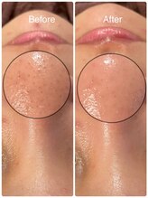 ビーアンドビー(B&B)/ハイドロコース