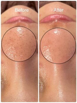 ビーアンドビー(B&B)/ハイドロコース