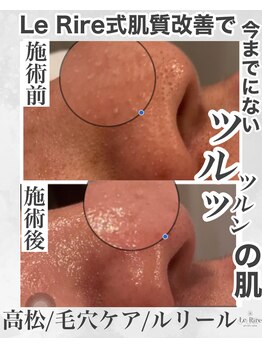 ルリール(Le Rire)/Le Rire式肌質改善