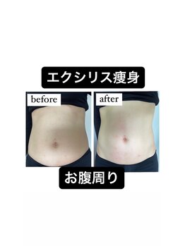 リベル(Liber)/むくんだお腹にエクシリス
