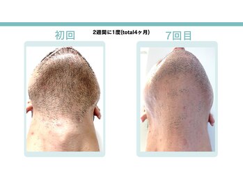 スターポルト(Star-Porte)/ヒゲ脱毛