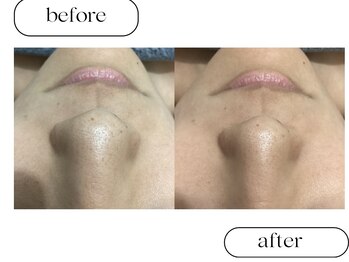 ルボン(RUBON)/鼻WAX＋ピーリング＋毛穴洗浄