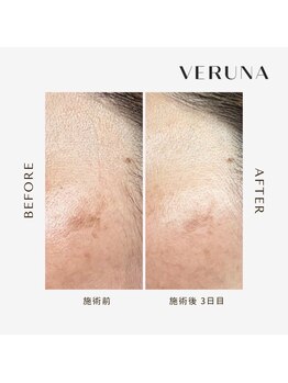 ココ 2号店(CoCo)/しみ改善/ハーブピーリング