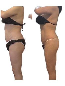 キュール(KuhL)/痩身ビフォーアフター☆