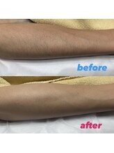 エーディーラボ(A.D LABO)/腕のbefore & afterです☆