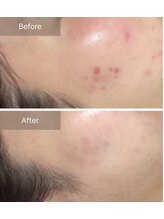 エミルカ 千葉店(EMILUCA)/ハーブピーリング顔/ニキビケア