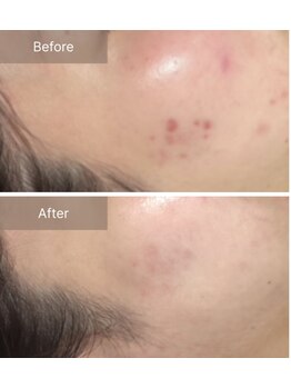 エミルカ 千葉店(EMILUCA)/ハーブピーリング顔/ニキビケア