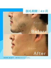 メンズクリア 八王子店/【メンズクリア】お客様の施術例