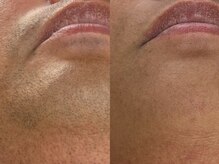 フェリス(FELIZ)/濃いひげの方も大丈夫！