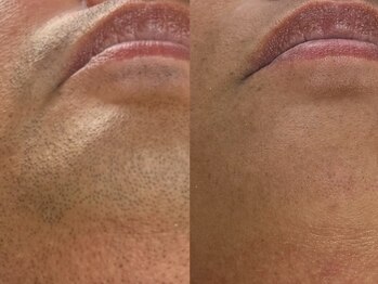 フェリス(FELIZ)/濃いひげの方も大丈夫!