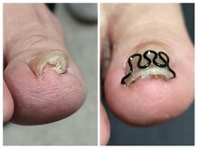 フレッシュフット(FreshFoot)/どんな巻き爪も対応★