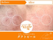 まいれ鍼灸院整骨院 整体院 草津院/ダクトピール/しみ