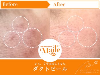 まいれ鍼灸院整骨院 整体院 草津院/ダクトピール/しみ