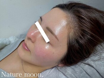 ナチュールムーン(Nature moon.)/ハーブピーリング　 after