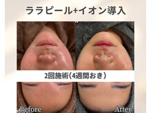 イーラボ 池袋店(e-LABO)/韓国肌管理/ララピール