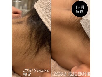 リネ(Rine)/【before→after】